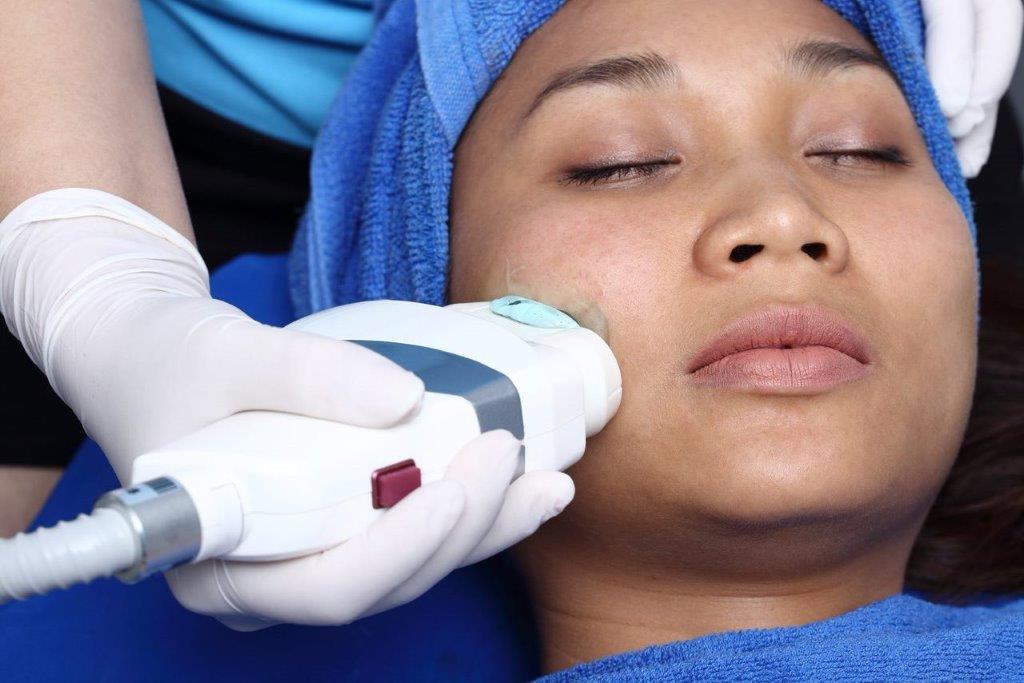 HIFU anti aging at simply skin deep in Bryanston, Sandton