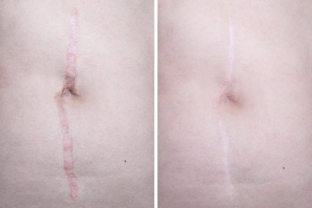 Microneedling at simply skin deep in Bryanston, Sandton