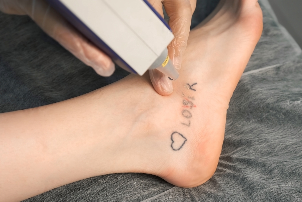 Tattoo Removal Simply Skin Deep Bryanston Sandton