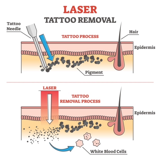 tattoo removal method at simply skin deep in bryanston sandton