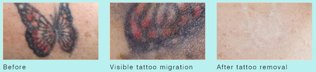 tattoo removal at simply skin deep in Bryanston, Sandton