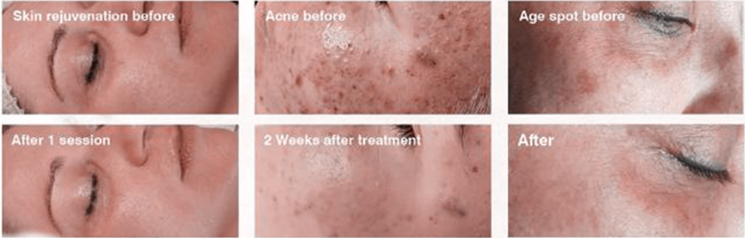 BLACK DIAMOND LASER THERAPY